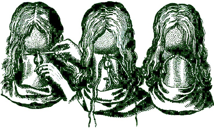 Making a Seton with Cautery, Sculltetus